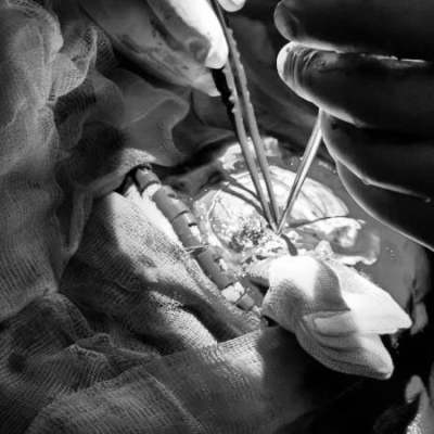 Врачи БСМП Челнов спасли многодетную мать с массивным кровоизлиянием в мозг